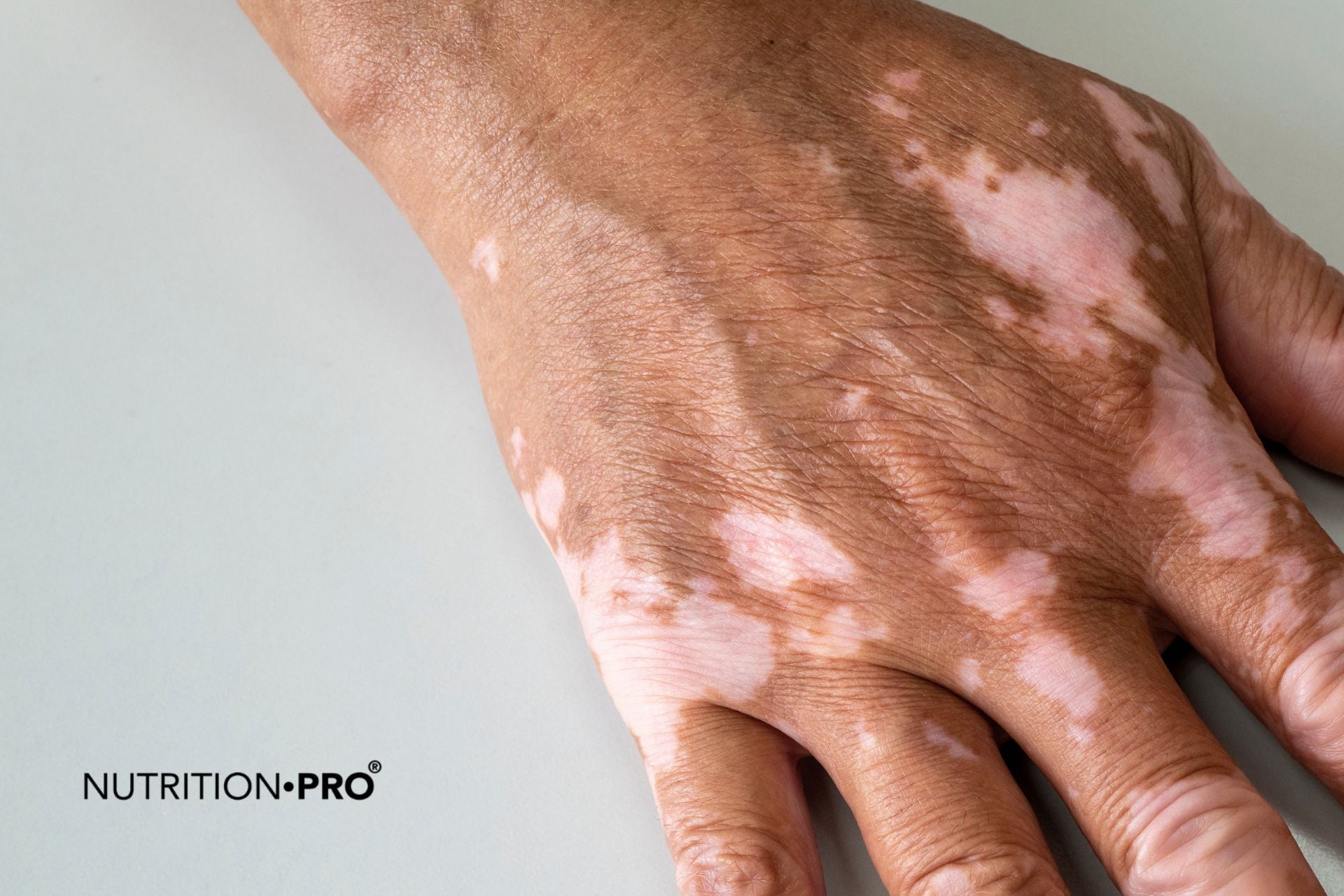 Vitiligo et repigmentation : guide scientifique complet 2026