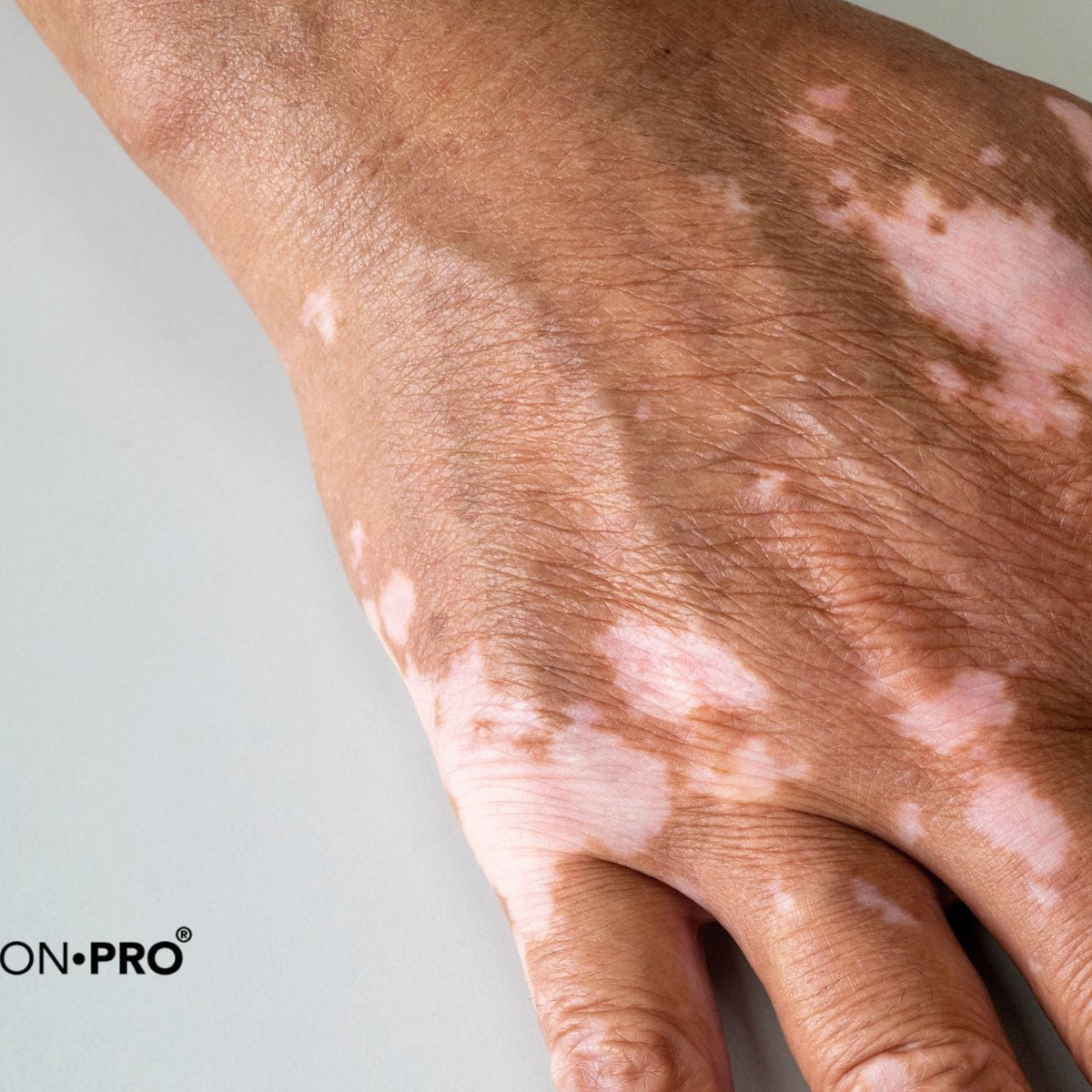 glutathione causes vitiligo DermaClinix | Vitiligo